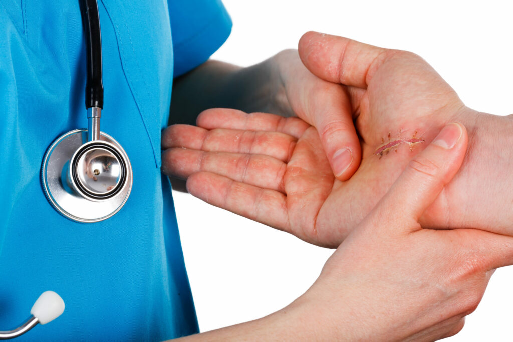 Doctor examining surgical suture on palm of hand
